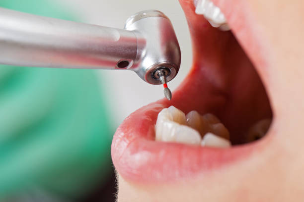 Emergency Dental Filling Replacement in IA